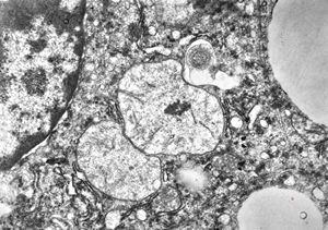 M,5y. | mitochondrial changes - Reye hepatocerebral syndrome